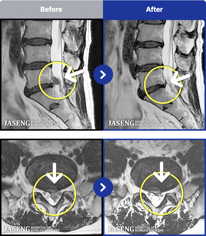 �ڻ��ѹ溴�� ġ���� MRI�� ���� ġ����-�㸮 ��� ������ �Բ� �ٸ��� ������ ���� �ȱⰡ �����.