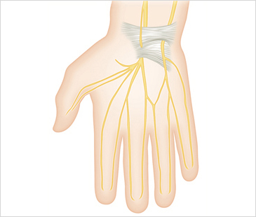 자생한방병원 기타관절질환 손목터널증후군-손목터널증후군에 관련된 이미지 입니다.