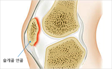 자생한방병원 무릎질환 슬개골연골연화증-슬개골 연골이 위치해 있는 무릎 설명 이미지