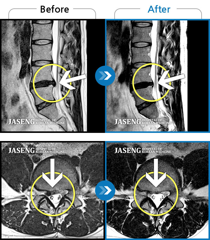 수원자생한방병원 치료 전후 MRI 비교 이미지