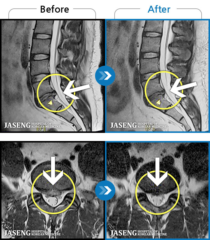 광주자생한방병원 치료 전후 MRI 비교 이미지