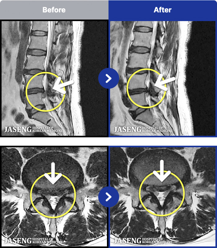 잠실자생한방병원 치료 전후 MRI 비교 이미지