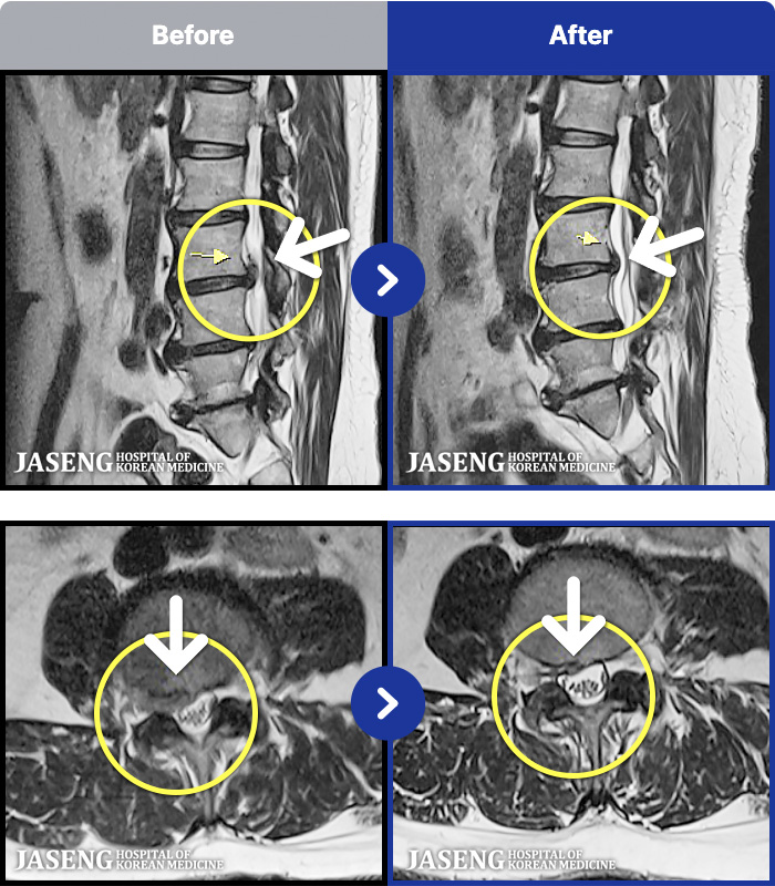 광주자생한방병원 치료 전후 MRI 비교 이미지